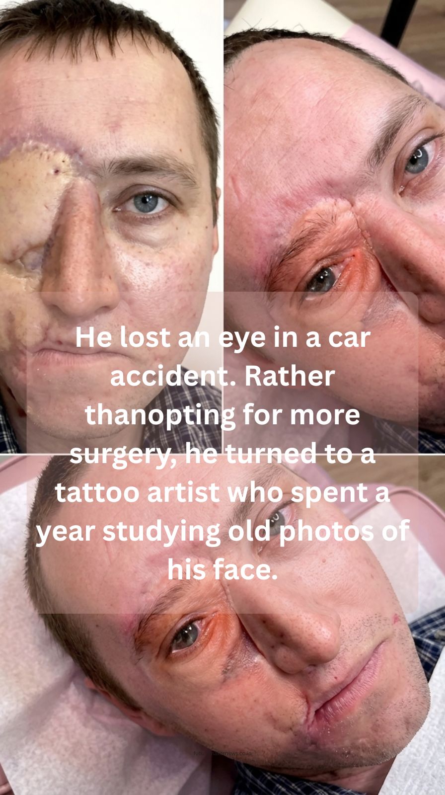 Man with hyper-realistic tattooed eye after accident, showcasing paramedical tattoo reconstruction and facial scar camouflage